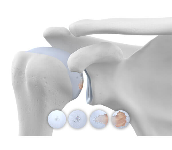 Illustration des Schultergelenks bei einer vorliegenden Omarthrose, inklusive der vier Arthrose-Stadien..