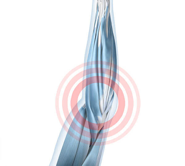 Illustration der Anatomie des Ellenbogens mit einer vorliegenden Sehnenansatzreizung.