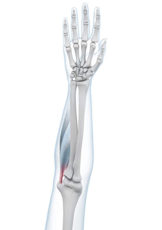 Illustration der Anatomie des Ellenbogens mit einem Golfarm.