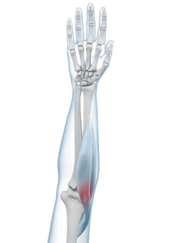 Darstellung der Anatomie des Ellenbogens mit einer Tennisarm-Erkrankung.